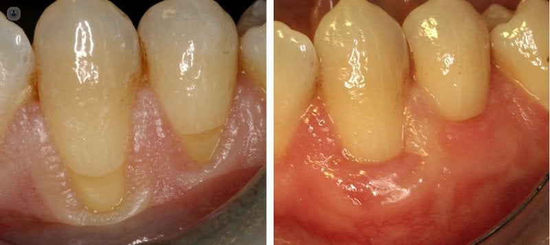 mucogingival