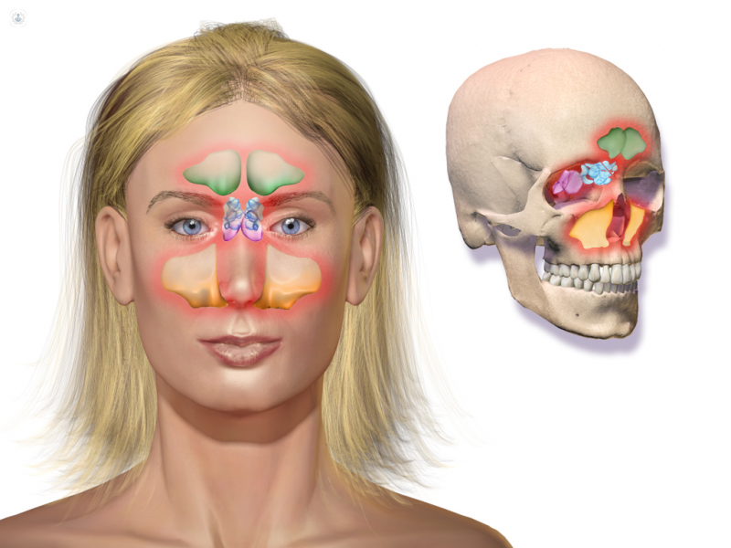 Esquema Sinusitis