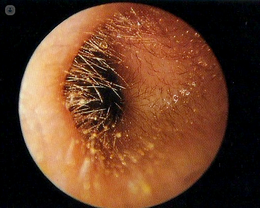 cerumen