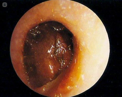 cerumen