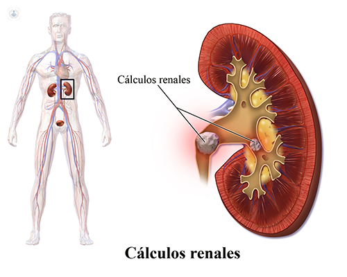 La litotricia extracorpórea por ondas de choque es la mejor terapia para las piedras en el riñón - Top Doctors