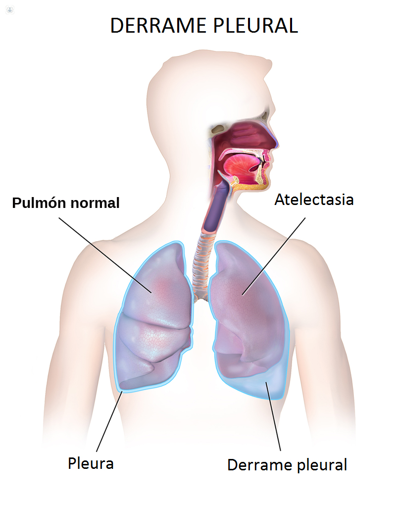 Derrame pleural