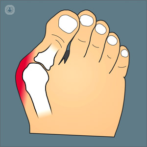 Juanete hallux valgus