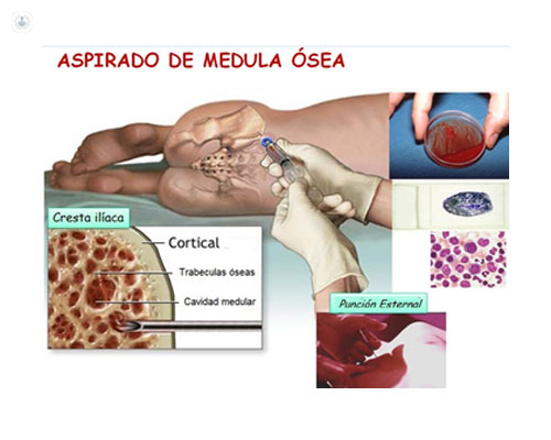 Proceso de extracción de material hematopoyético - Top Doctors