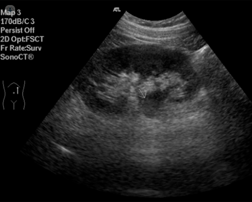 litiasis-renal